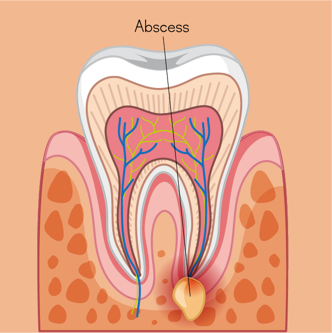 What Is A Dental Abscess