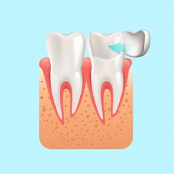 Emergency Dentistry - Dental Veneer