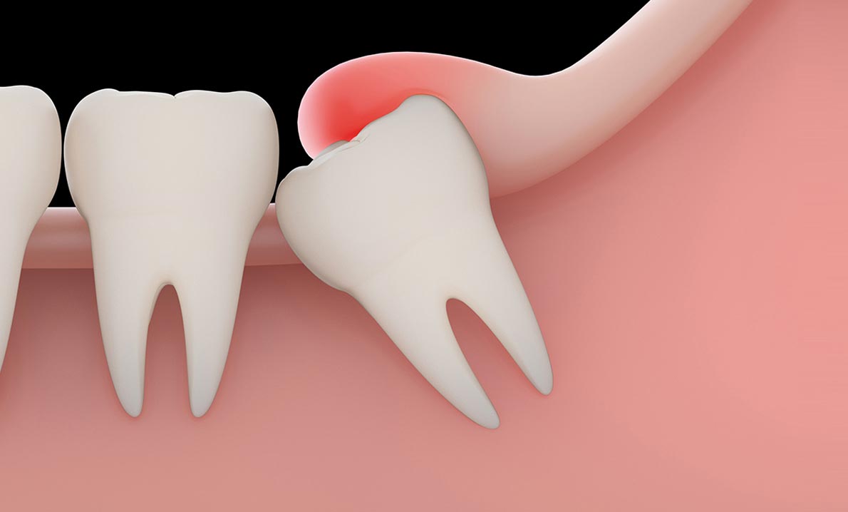 Emergency impacted tooth treatment London