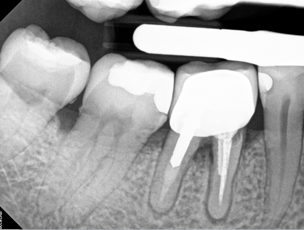 Tooth X-ray root canal treatment