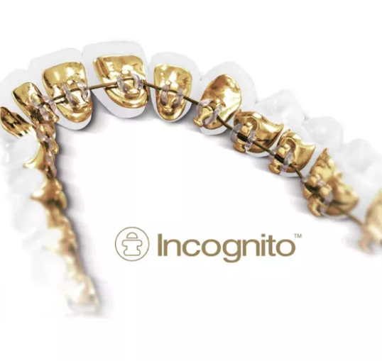 Incognito Full braces