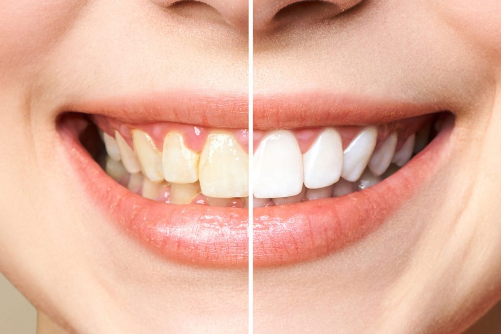 How white can teeth become after whitening