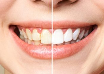 How White Can Teeth Become After Whitening